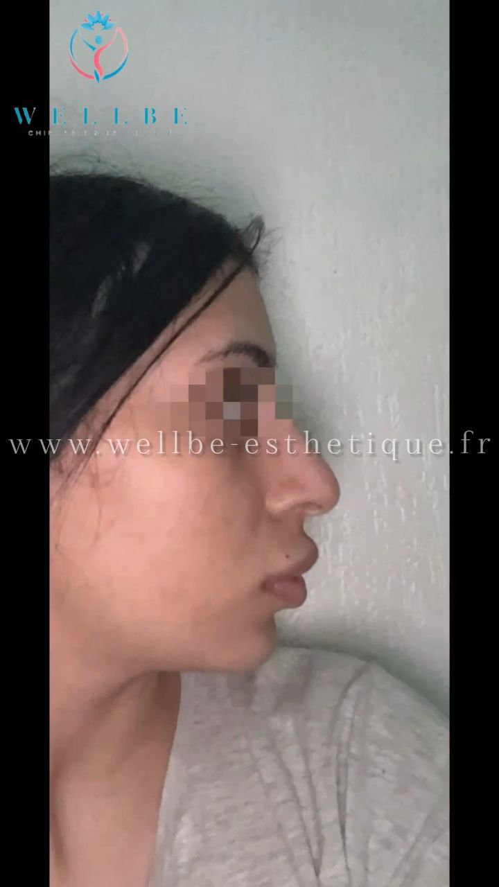Résultat IMMÉDIAT 🔥 Rhinoplastie 🔥
————————————————————————
☎️Contactez-nous pour un Devis gratuit et personnalisé
WhatsApp 📲 + 216 52 869 696
📧 devis@wellbe-esthetique.fr 
https://wellbe-esthetique.fr/
-————————————————————————
#chirurgieesthetique #plasticsurgery #chirurgieplastique #medecineesthetique #chirurgienesthetique #augmentationmammaire #rhinoplastie #liposuccion #tummytuck #bbl #facelift #botox #fillers #acidehyaluronique #avantapres #transformation #beauty #aesthetic #cosmeticsurgery #beforeandafter #plasticsurgeon #chirurgienplasticien #chirurgieesthetiqueparis #tunisie #paris #france#wellbechirurgieesthetique#wellbetunisie#wellbe