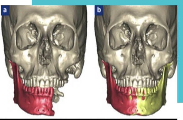 reconstruction mandibulaire wellbe chirurgie esthétique