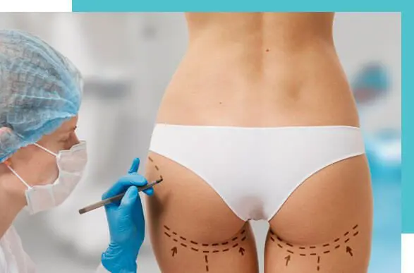 LIPOFILLING-FESSIER wellbe chirurgie esthétique