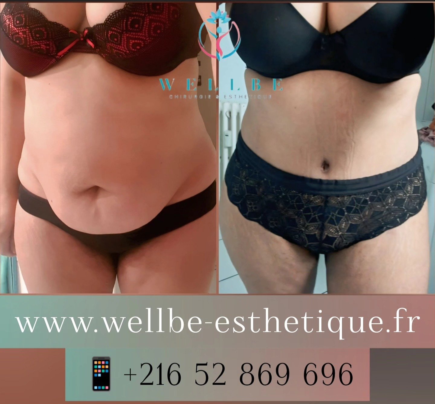 Résultat IMMÉDIAT 🔥Liposuccion plusieurs zones avec Abdominoplastie 🔥
————————————————————————
☎️Contactez-nous pour un Devis gratuit et personnalisé
WhatsApp 📲 + 216 52 869 696
📧 devis@wellbe-esthetique.fr 
https://wellbe-esthetique.fr/
-————————————————————————
#chirurgieesthetique #plasticsurgery #chirurgieplastique #medecineesthetique #chirurgienesthetique #augmentationmammaire #rhinoplastie #liposuccion #tummytuck #bbl #facelift #botox #fillers #acidehyaluronique #avantapres #transformation #beauty #aesthetic #cosmeticsurgery #beforeandafter #plasticsurgeon #chirurgienplasticien #chirurgieesthetiqueparis #tunisie #paris #france#wellbechirurgieesthetique#wellbetunisie#wellbe