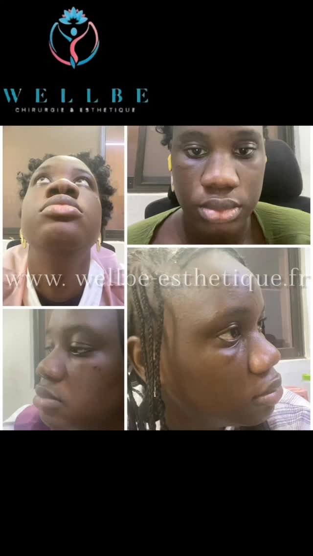 Résultat immédiat 🔥 Rhinoplastie Ethnique 🔥
————————————————————————
☎️Contactez-nous pour un Devis gratuit et personnalisé
WhatsApp 📲 + 216 52 869 696
📧 devis@wellbe-esthetique.fr 
https://wellbe-esthetique.fr/
-————————————————————————
#chirurgieesthetique #plasticsurgery #chirurgieplastique #medecineesthetique #chirurgienesthetique