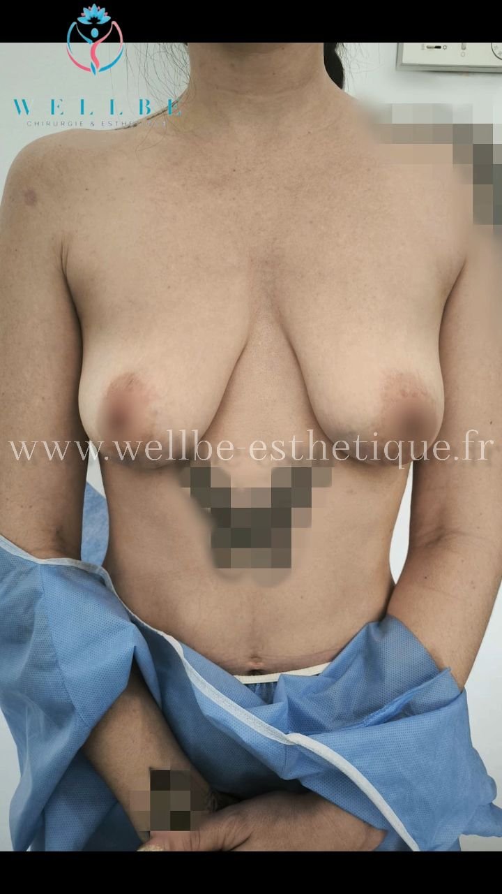 Résultat immédiat 🔥Lifting mammaire avec prothèses 🔥
————————————————————————
☎️Contactez-nous pour un Devis gratuit et personnalisé
WhatsApp 📲 + 216 52 869 696
📧 devis@wellbe-esthetique.fr 
https://wellbe-esthetique.fr/
-————————————————————————
#chirurgieesthetique #plasticsurgery #chirurgieplastique #medecineesthetique #chirurgienesthetique