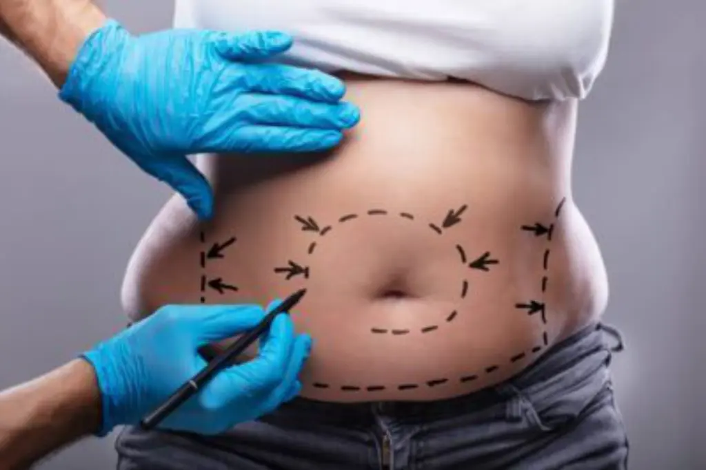 liposuccion chirurgie Tunisie