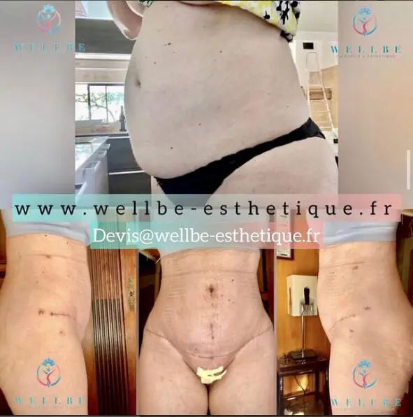 Abdomiboplastie Tunisie