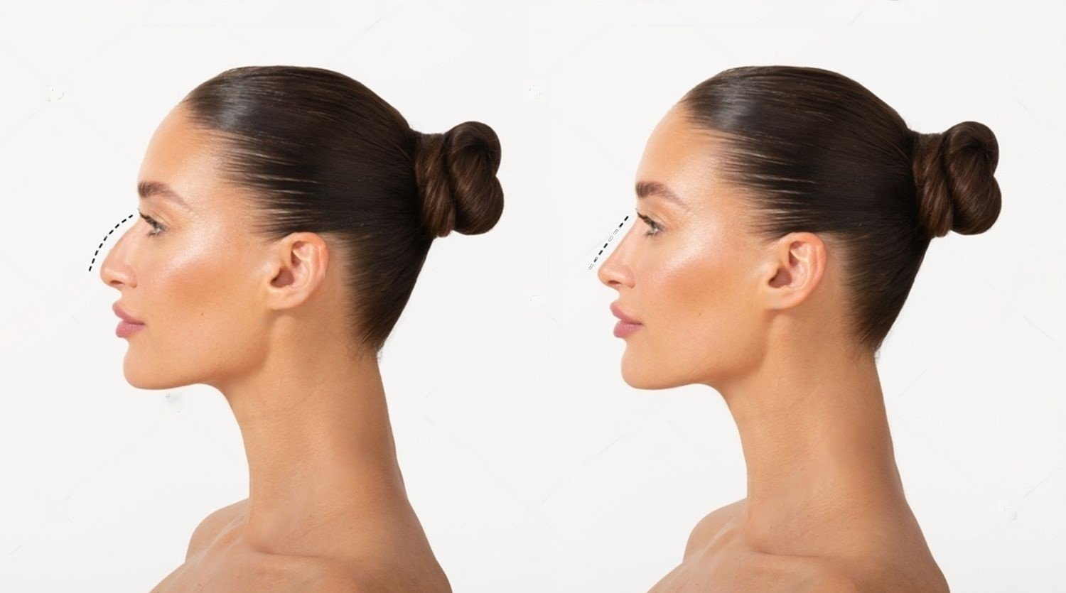 Découvrez la rhinoplastie