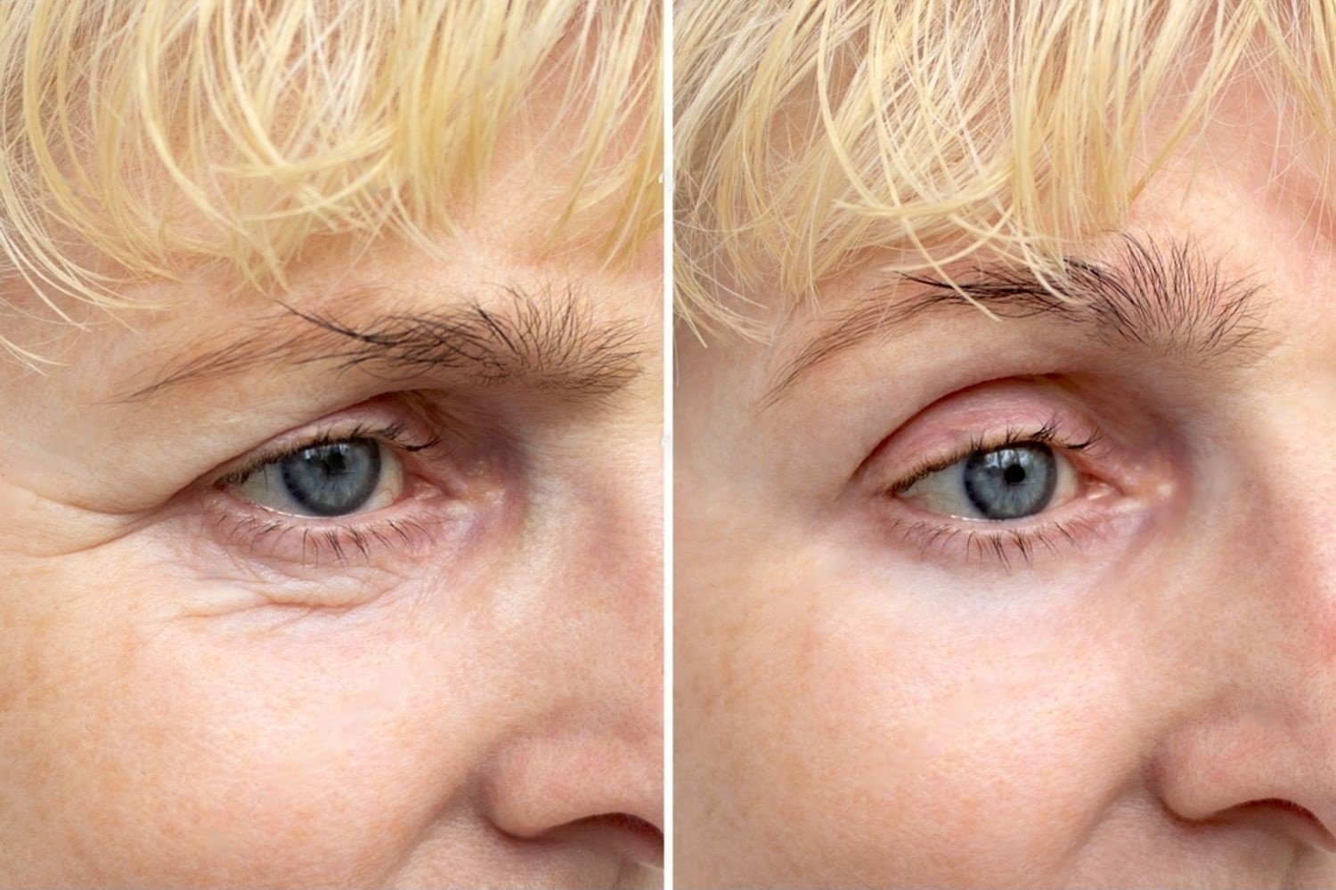 Psychologique de la Blépharoplastie