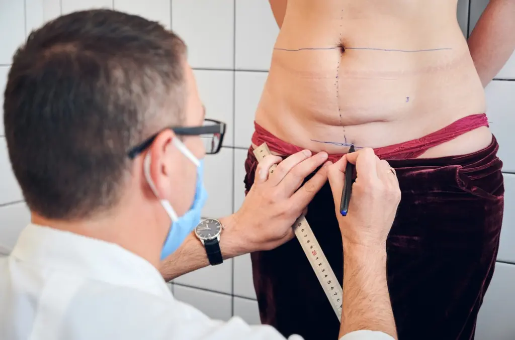 abdominoplasties classique et circulaire