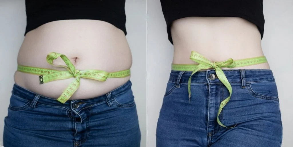 Résultats Abdominoplastie