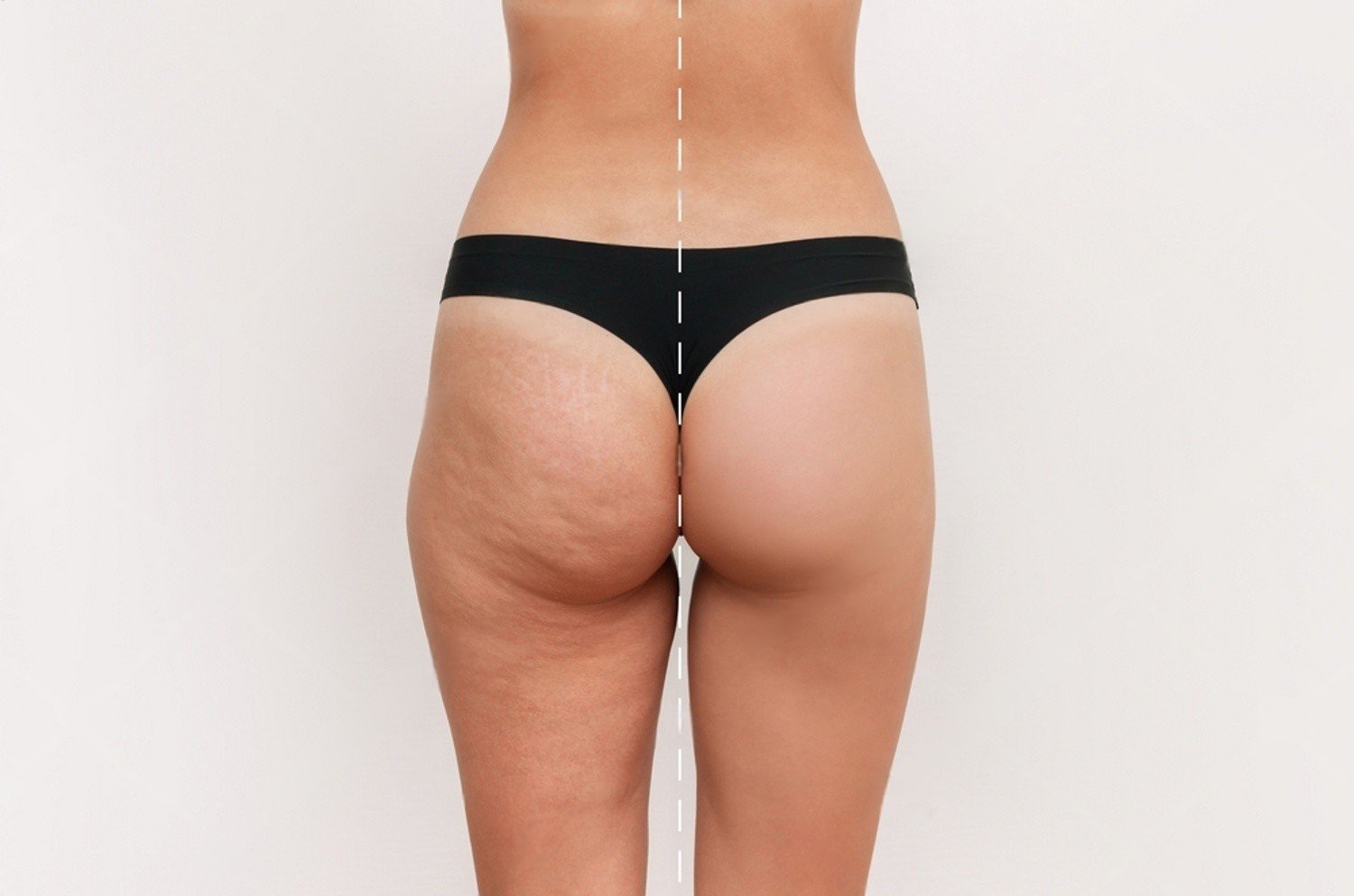 Lifting cuisses