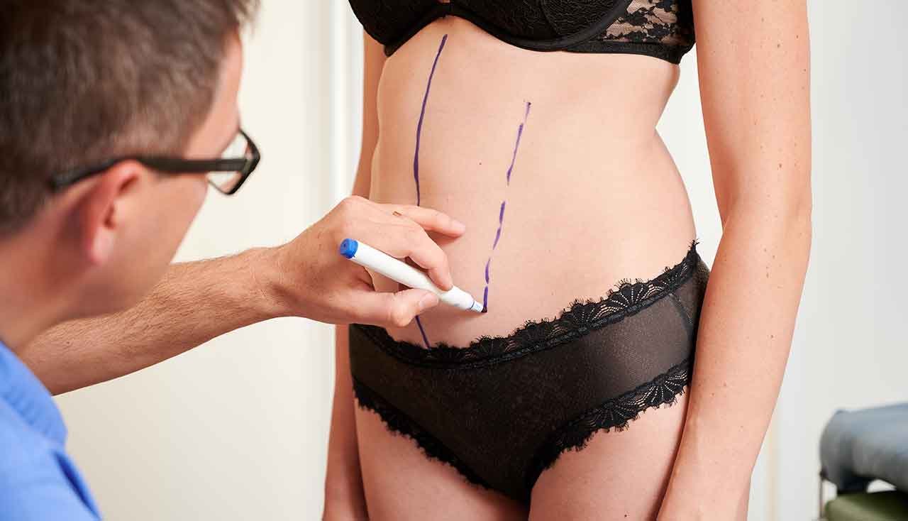 À qui s’adresse la liposuccion