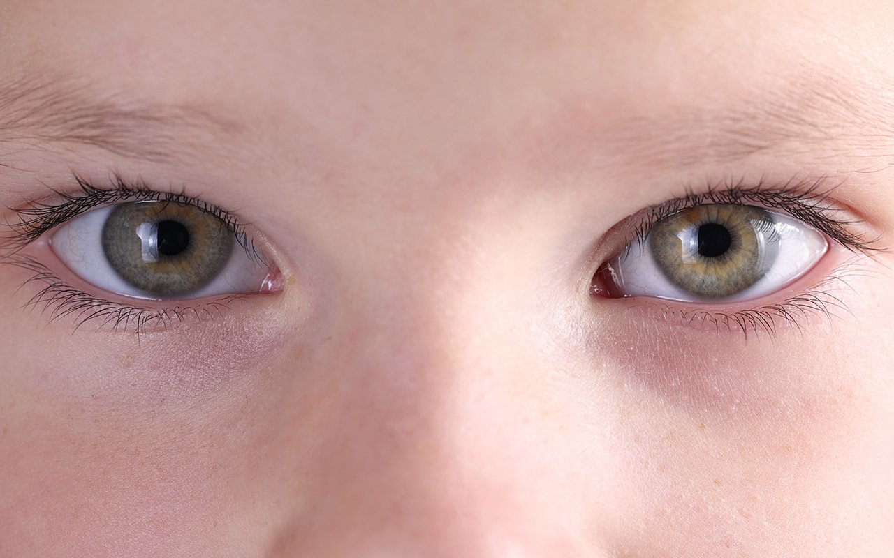 Canthopexie en Tunisie le séjour esthétique