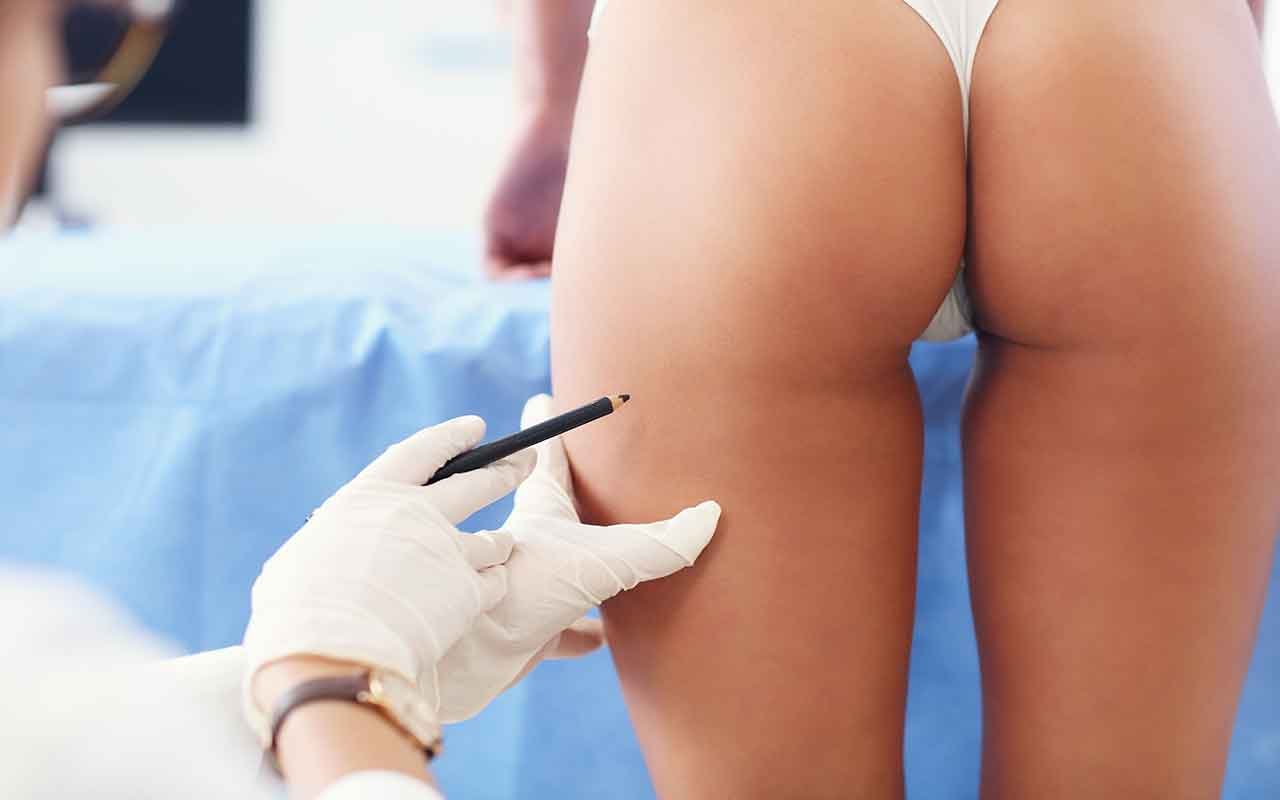 Lifting cuisses déroulement de l’intervention 