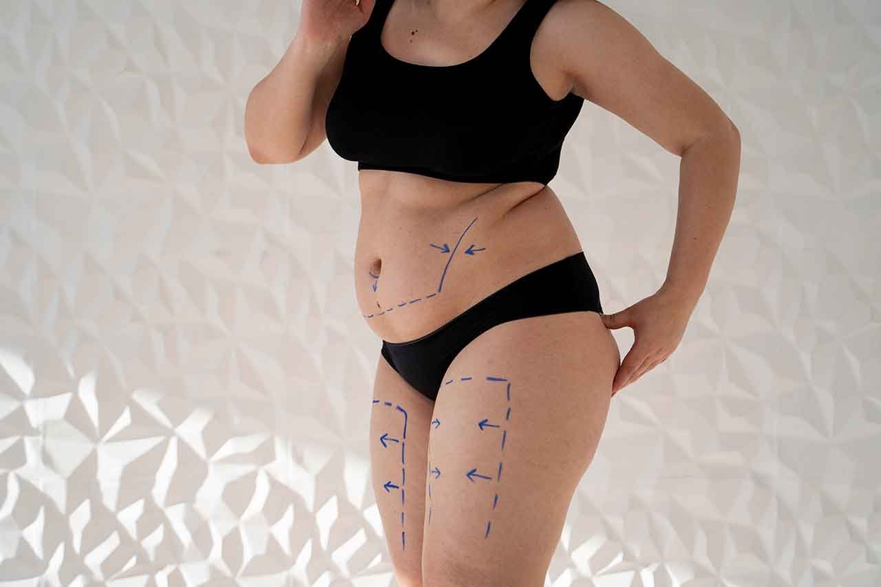 Pourquoi ne pas faire une abdominoplastie trop tôt après l’accouchement Pourquoi ne pas faire une abdominoplastie trop tôt après l’accouchement