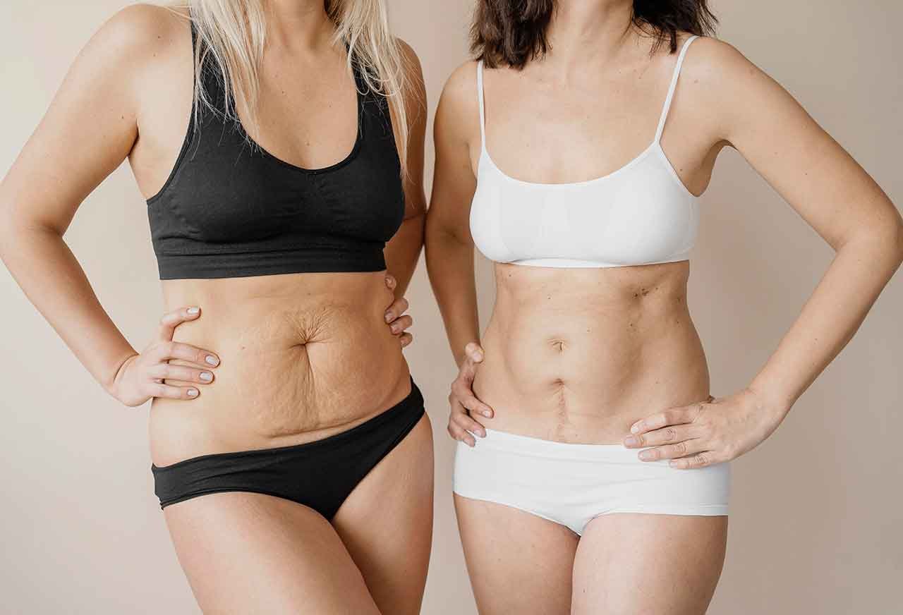 Quels signes indiquent qu’une abdominoplastie est envisageable Quels signes indiquent qu’une abdominoplastie est envisageable