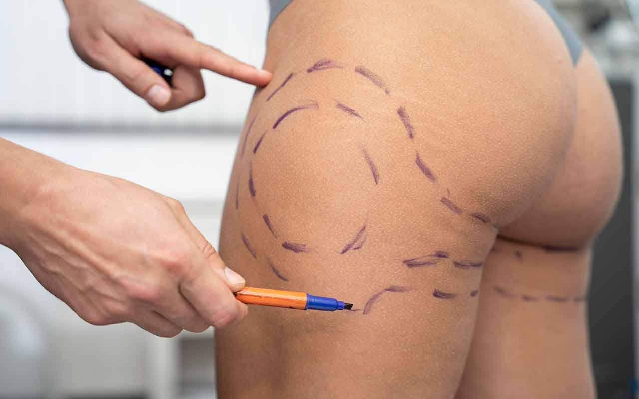 bbl Soins post opératoires et récupération bbl Soins post opératoires et récupération