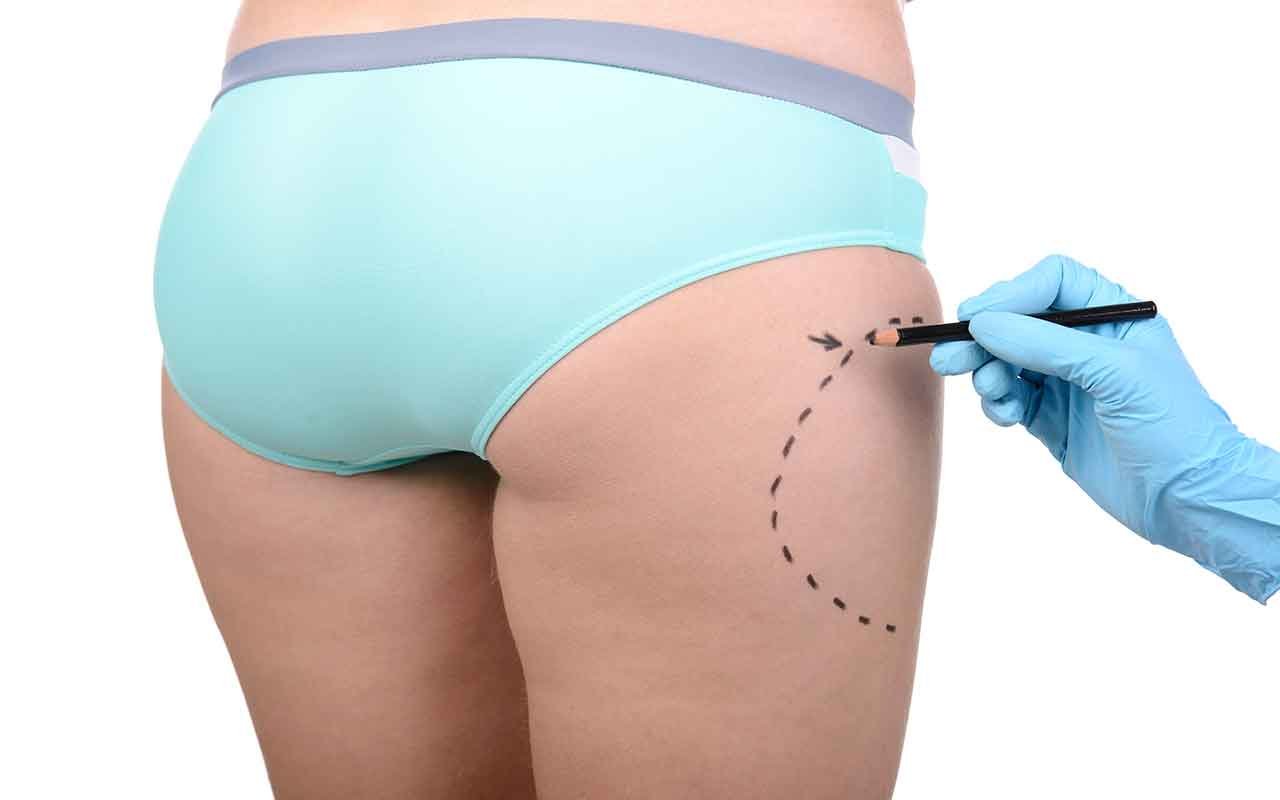 durée du séjour pour un BBL en Tunisie durée du séjour pour un BBL en Tunisie