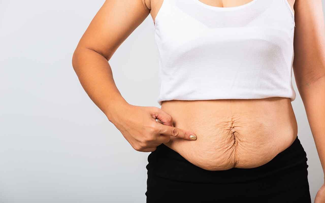 Abdominoplastie combien de temps pour dégonfler
