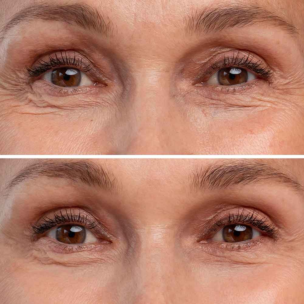Blépharoplastie quel âge moyen pour se lancer