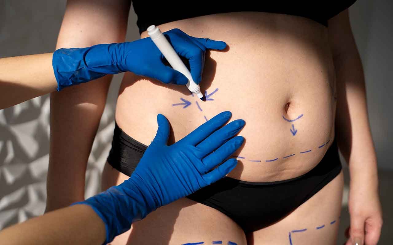 Êtes vous une bonne candidate pour une abdominoplastie après grossesse Êtes vous une bonne candidate pour une abdominoplastie après grossesse