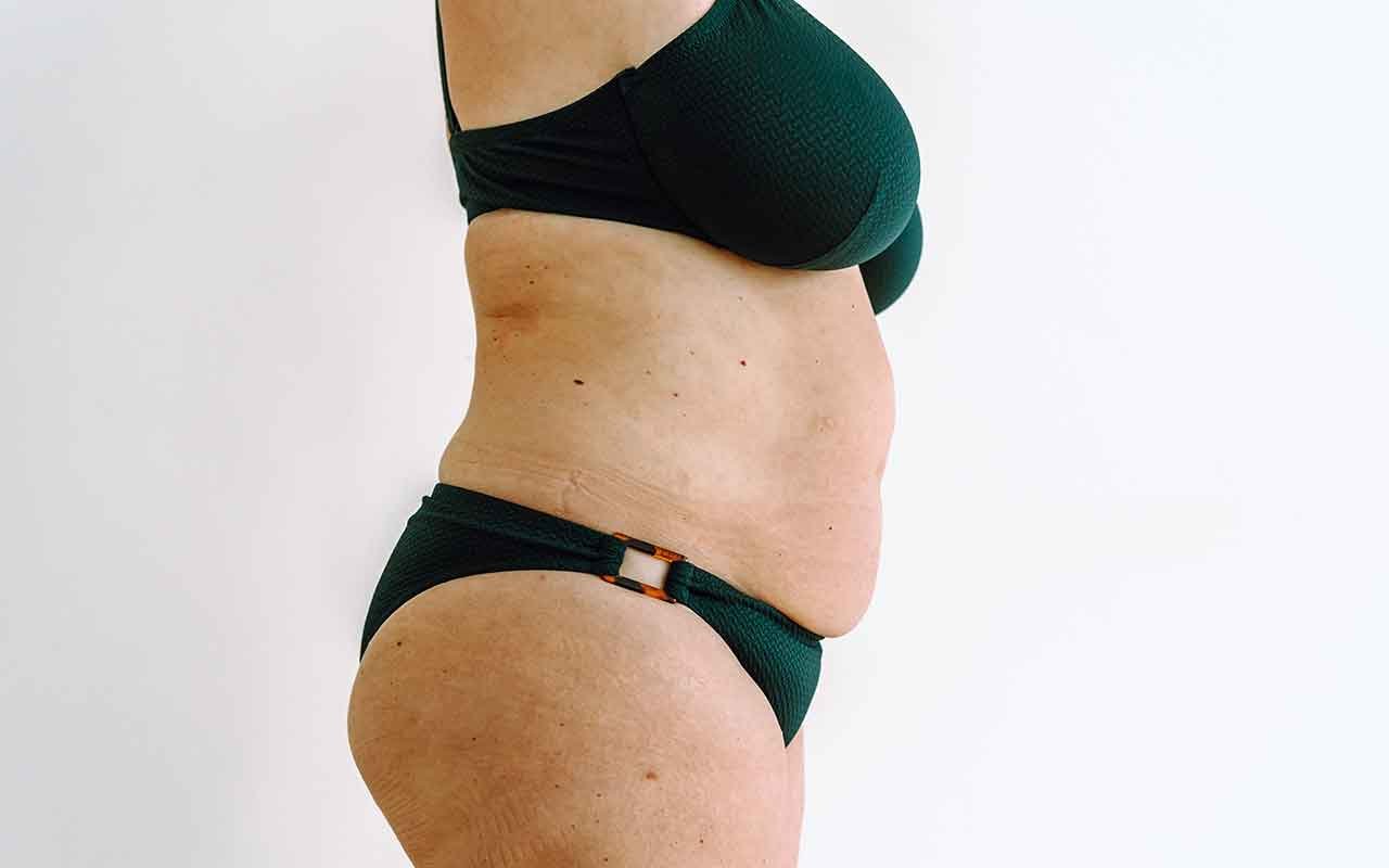 Mini abdominoplastie en Tunisie le secret d’un ventre plat sans chirurgie lourd