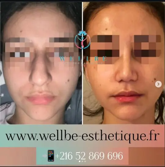 Rhinoplastie Tunisie