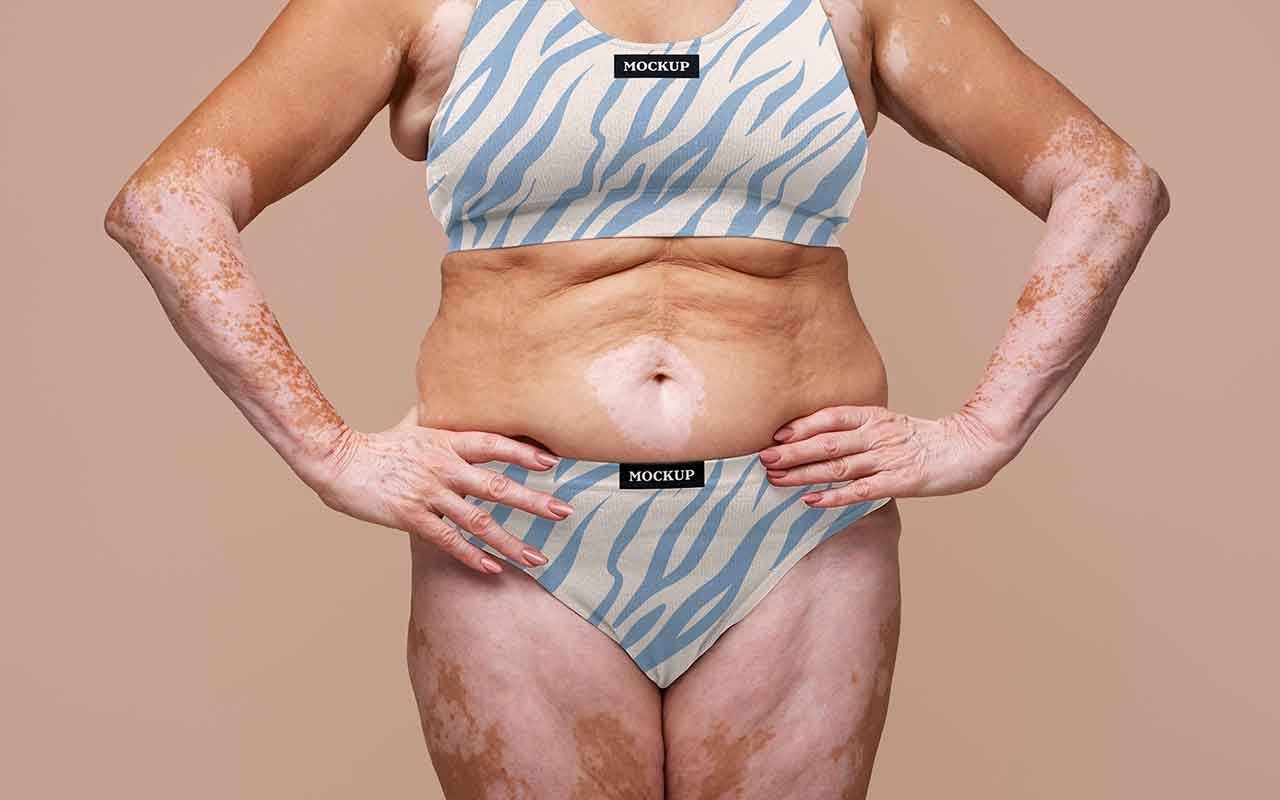 Pourquoi faire une mini abdominoplastie en Tunisie