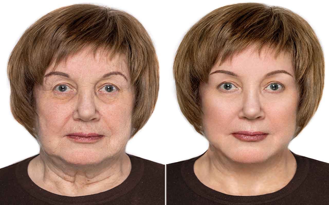 Qu’est ce que le lipofilling des cernes