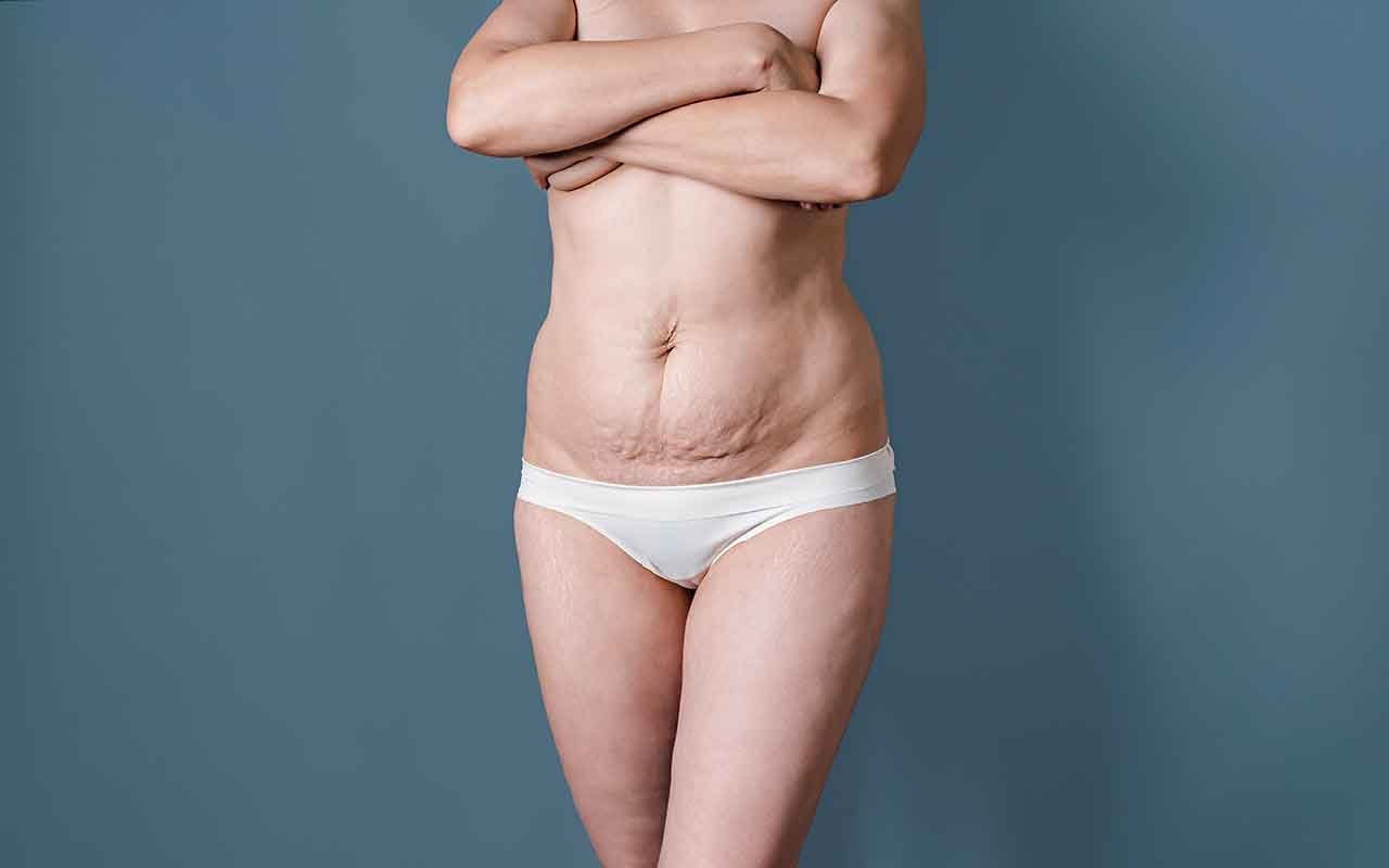 causes de l’excès de peau abdominal