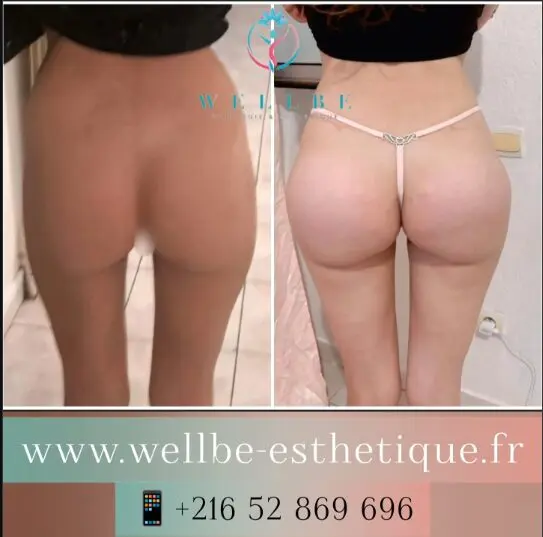 implant fessier tunisie implant fessier tunisie