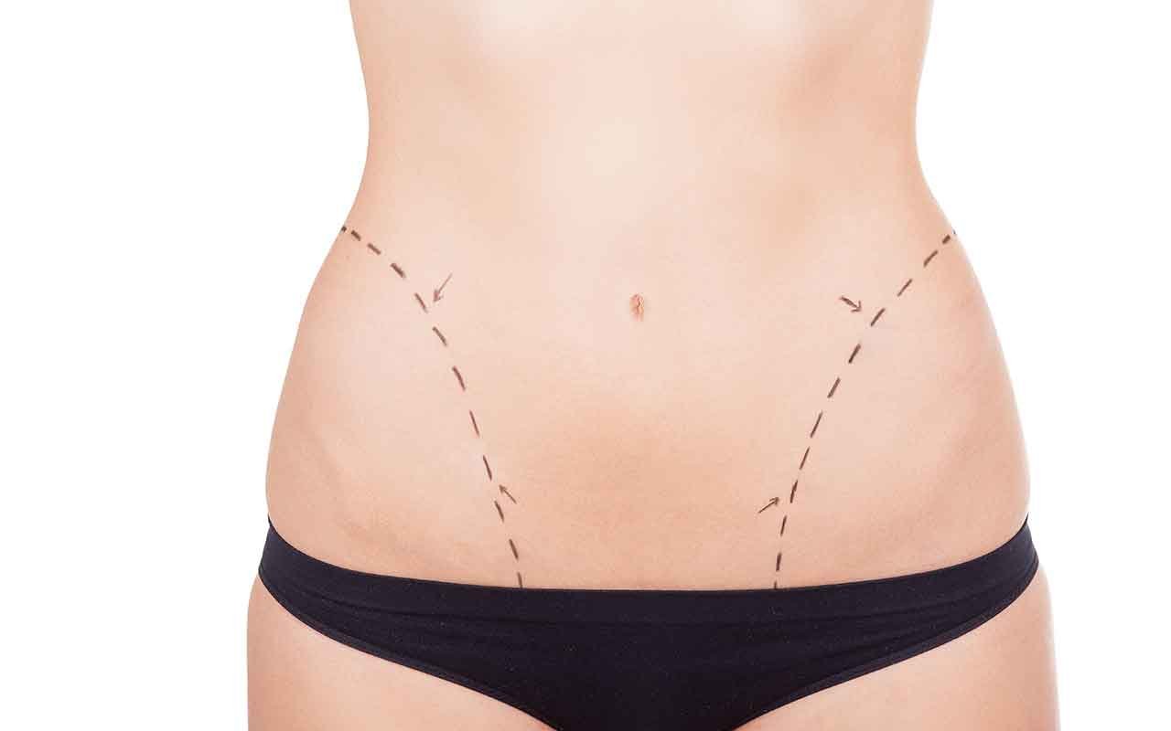 résultats attendre d’un bodylift post bariatrique