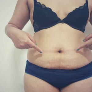 Aspiration de la graisse du ventre