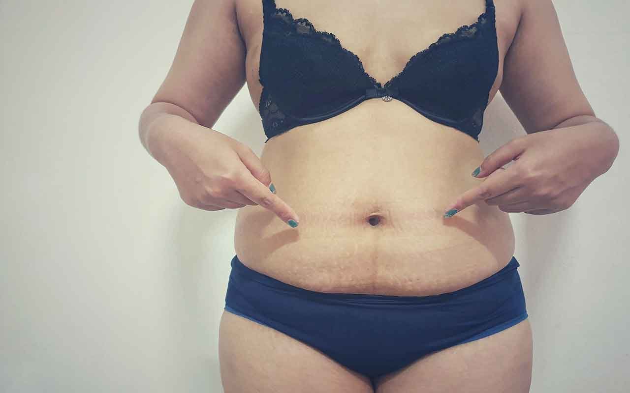 Aspiration de la graisse du ventre
