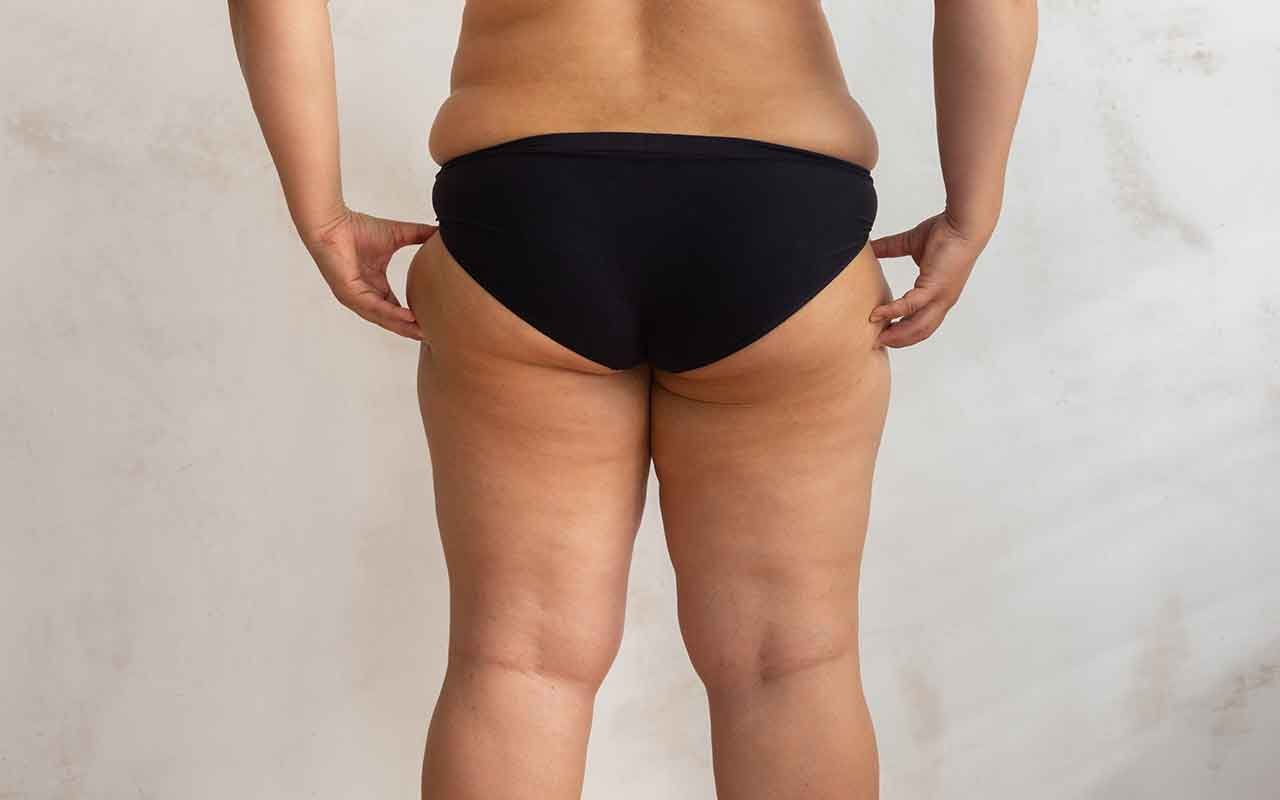 Chirurgie post bariatrique le lifting des cuisses