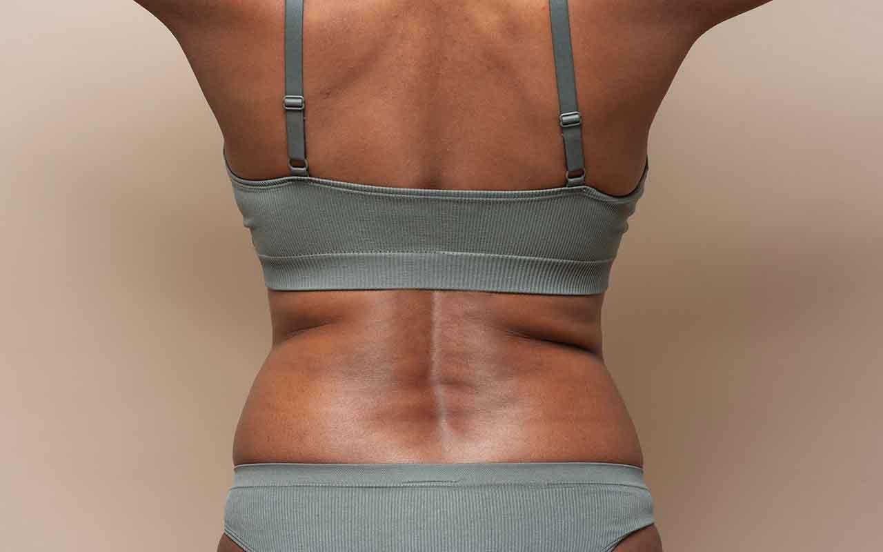 Évolution de la cicatrice après un lifting du dos Évolution de la cicatrice après un lifting du dos