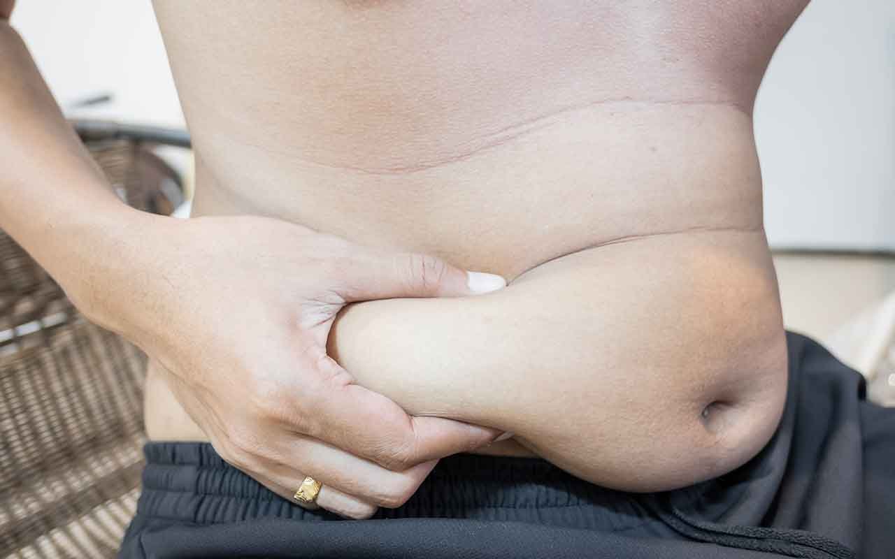 Liposuccion du ventre  1 mois