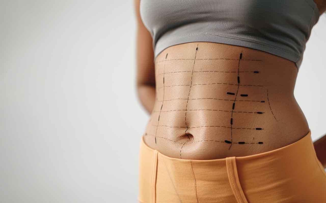 Reprise de la marche après une abdominoplastie