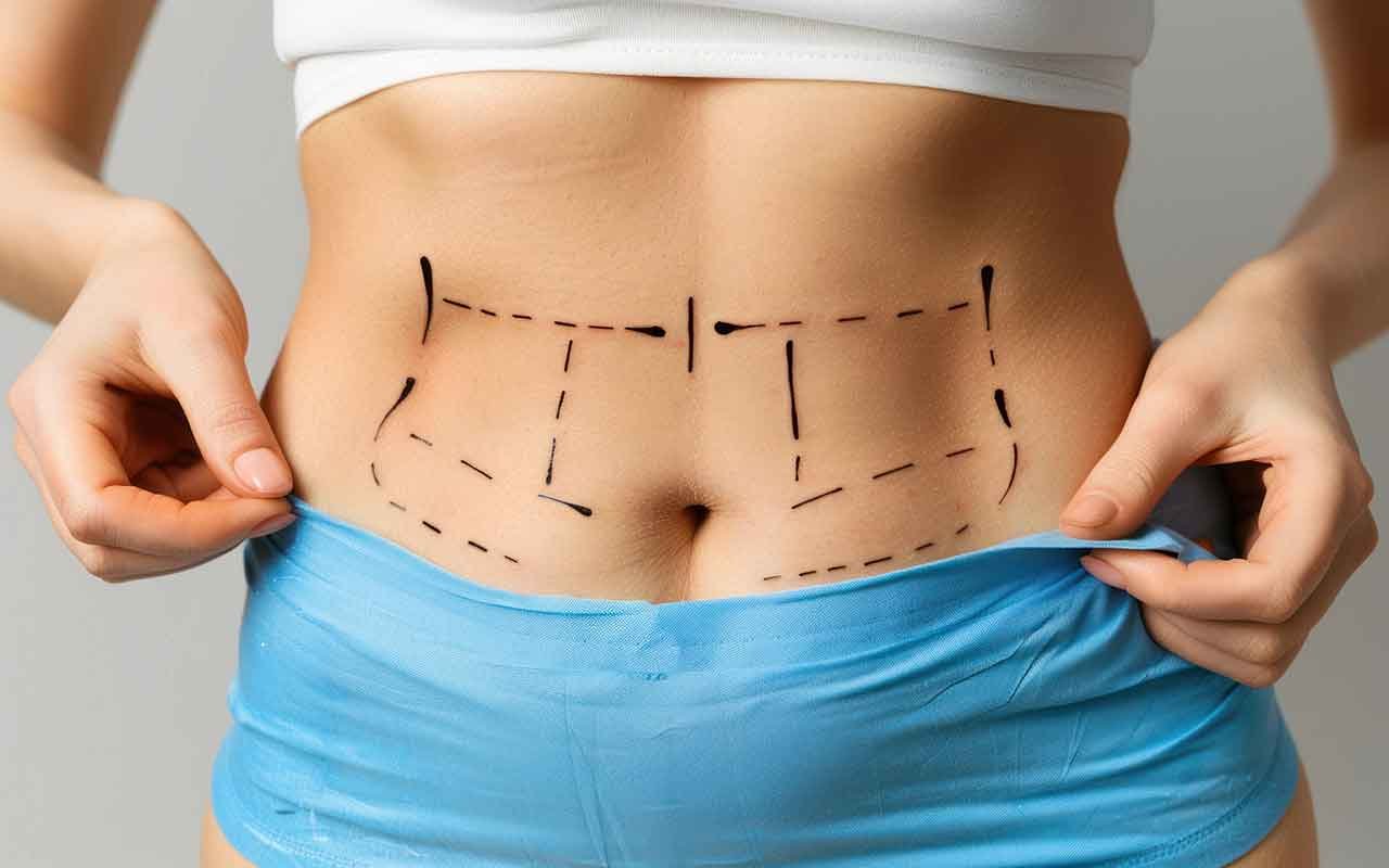 abdominoplastie-tunisie