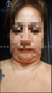 Résultats Immédiat 🔥Lifting cou🔥
————————————————————————
☎️Contactez-nous pour un Devis gratuit et personnalisé
WhatsApp 📲 + 216 52 869 696
📧 devis@wellbe-esthetique.fr
https://wellbe-esthetique.fr/
-————————————————————————
#wellbe#chirurgieesthetique #lipofilling#brazilianbutt #fesses #lipofillingfessierstunisie#bbl#lipofilling #chirurgie #lipofillingfessiers #abdominoplastie #abdominoplasty #liposuccion #beauty#lifting #mommymakeover #wellbechirurgieesthetique #santé #health #perfectlook