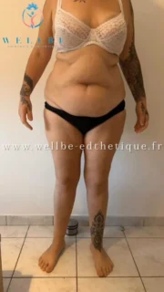 Résultats Immédiat 🔥 Liposuccion avec abdominoplastie 🔥
————————————————————————
☎️Contactez-nous pour un Devis gratuit et personnalisé
WhatsApp 📲 + 216 52 869 696
📧 devis@wellbe-esthetique.fr
https://wellbe-esthetique.fr/
-————————————————————————
#wellbe#chirurgieesthetique #lipofilling#brazilianbutt #fesses #lipofillingfessierstunisie#bbl#lipofilling #chirurgie #lipofillingfessiers #abdominoplastie #abdominoplasty #liposuccion #beauty#lifting #mommymakeover #wellbechirurgieesthetique #santé #health #perfectlook