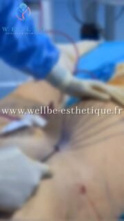 Résultats Immédiat 🔥 J plasma plusieurs zones 🔥
————————————————————————
☎️Contactez-nous pour un Devis gratuit et personnalisé
WhatsApp 📲 + 216 52 869 696
📧 devis@wellbe-esthetique.fr
https://wellbe-esthetique.fr/
-————————————————————————
#wellbe#chirurgieesthetique #lipofilling#brazilianbutt #fesses #lipofillingfessierstunisie#bbl#lipofilling #chirurgie #lipofillingfessiers #abdominoplastie #abdominoplasty #liposuccion #beauty#lifting #mommymakeover #wellbechirurgieesthetique #santé #health #perfectlook