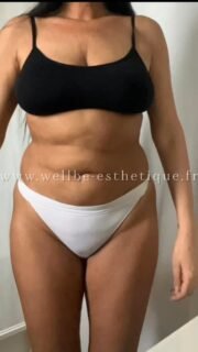 Résultats Immédiat 🔥 Liposuccion avec Abdominoplastie + BBL 🔥
————————————————————————
☎️Contactez-nous pour un Devis gratuit et personnalisé
WhatsApp 📲 + 216 52 869 696
📧 devis@wellbe-esthetique.fr
https://wellbe-esthetique.fr/
-————————————————————————
#wellbe#chirurgieesthetique #lipofilling#brazilianbutt #fesses #lipofillingfessierstunisie#bbl#lipofilling #chirurgie #lipofillingfessiers #abdominoplastie #abdominoplasty #liposuccion #beauty#lifting #mommymakeover #wellbechirurgieesthetique #santé #health #perfectlook