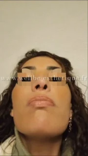 Dr Riadh el fatmi 🔥 Rhinoplastie secondaire 🔥
————————————————————————
☎️Contactez-nous pour un Devis gratuit et personnalisé
WhatsApp 📲 + 216 52 869 696
📧 devis@wellbe-esthetique.fr
https://wellbe-esthetique.fr/
-————————————————————————
#wellbe#chirurgieesthetique #lipofilling#brazilianbutt #fesses #lipofillingfessierstunisie#bbl#lipofilling #chirurgie #lipofillingfessiers #abdominoplastie #abdominoplasty #liposuccion #beauty#lifting #mommymakeover #wellbechirurgieesthetique #santé #health #perfectlook