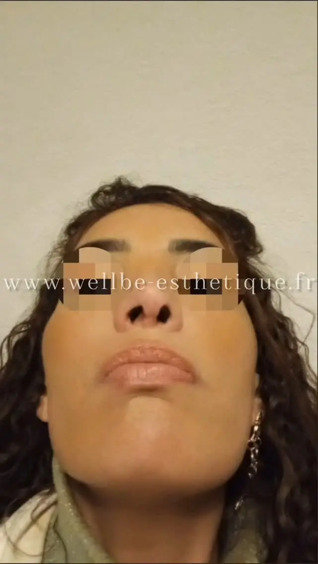Dr Riadh el fatmi 🔥 Rhinoplastie secondaire 🔥
————————————————————————
☎️Contactez-nous pour un Devis gratuit et personnalisé
WhatsApp 📲 + 216 52 869 696
📧 devis@wellbe-esthetique.fr
https://wellbe-esthetique.fr/
-————————————————————————
#wellbe#chirurgieesthetique #lipofilling#brazilianbutt #fesses #lipofillingfessierstunisie#bbl#lipofilling #chirurgie #lipofillingfessiers #abdominoplastie #abdominoplasty #liposuccion #beauty#lifting #mommymakeover #wellbechirurgieesthetique #santé #health #perfectlook