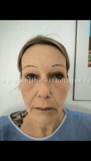 Résultats J + 30 🔥 Lifting cervico facial + blépharoplastie 🔥
————————————————————————
☎️Contactez-nous pour un Devis gratuit et personnalisé
WhatsApp 📲 + 216 52 869 696
📧 devis@wellbe-esthetique.fr
https://wellbe-esthetique.fr/
-————————————————————————
#wellbe#chirurgieesthetique #lipofilling#brazilianbutt #fesses #lipofillingfessierstunisie#bbl#lipofilling #chirurgie #lipofillingfessiers #abdominoplastie #abdominoplasty #liposuccion #beauty#lifting #mommymakeover #wellbechirurgieesthetique #santé #health #perfectlook