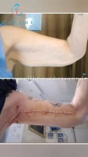 Résultats J + 30 🔥 Lifting bras + Lifting cuisse 🔥
————————————————————————
☎️Contactez-nous pour un Devis gratuit et personnalisé
WhatsApp 📲 + 216 52 869 696
📧 devis@wellbe-esthetique.fr
https://wellbe-esthetique.fr/
-————————————————————————
#wellbe#chirurgieesthetique #lipofilling#brazilianbutt #fesses #lipofillingfessierstunisie#bbl#lipofilling #chirurgie #lipofillingfessiers #abdominoplastie #abdominoplasty #liposuccion #beauty#lifting #mommymakeover #wellbechirurgieesthetique #santé #health #perfectlook