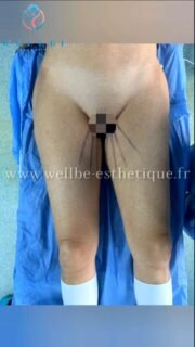 Résultats Immédiat 🔥 J plasma cuisses 🔥
————————————————————————
☎️Contactez-nous pour un Devis gratuit et personnalisé
WhatsApp 📲 + 216 52 869 696
📧 devis@wellbe-esthetique.fr
https://wellbe-esthetique.fr/
-————————————————————————
#wellbe#chirurgieesthetique #lipofilling#brazilianbutt #fesses #lipofillingfessierstunisie#bbl#lipofilling #chirurgie #lipofillingfessiers #abdominoplastie #abdominoplasty #liposuccion #beauty#lifting #mommymakeover #wellbechirurgieesthetique #santé #health #perfectlook