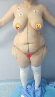 🔥 Liposuccion plusieurs zones avec Abdominoplastie 🔥
————————————————————————
☎️Contactez-nous pour un Devis gratuit et personnalisé
WhatsApp 📲 + 216 52 869 696
📧 devis@wellbe-esthetique.fr
https://wellbe-esthetique.fr/
-————————————————————————
#wellbe#chirurgieesthetique #lipofilling#brazilianbutt #fesses #lipofillingfessierstunisie#bbl#lipofilling #chirurgie #lipofillingfessiers #abdominoplastie #abdominoplasty #liposuccion #beauty#lifting #mommymakeover #wellbechirurgieesthetique #santé #health #perfectlook