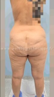 Résultats Immédiat 🔥 Liposculpture 🔥
————————————————————————
☎️Contactez-nous pour un Devis gratuit et personnalisé
WhatsApp 📲 + 216 52 869 696
📧 devis@wellbe-esthetique.fr
https://wellbe-esthetique.fr/
-————————————————————————
#wellbe#chirurgieesthetique #lipofilling#brazilianbutt #fesses #lipofillingfessierstunisie#bbl#lipofilling #chirurgie #lipofillingfessiers #abdominoplastie #abdominoplasty #liposuccion #beauty#lifting #mommymakeover #wellbechirurgieesthetique #santé #health #perfectlook