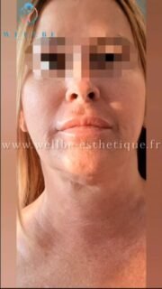 Résultats Immédiat 🔥 Lifting cervico facial 🔥
————————————————————————
☎️Contactez-nous pour un Devis gratuit et personnalisé
WhatsApp 📲 + 216 52 869 696
📧 devis@wellbe-esthetique.fr
https://wellbe-esthetique.fr/
-————————————————————————
#wellbe#chirurgieesthetique #lipofilling#brazilianbutt #fesses #lipofillingfessierstunisie#bbl#lipofilling #chirurgie #lipofillingfessiers #abdominoplastie #abdominoplasty #liposuccion #beauty#lifting #mommymakeover #wellbechirurgieesthetique #santé #health #perfectlook