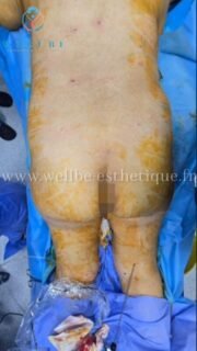 🔥 Liposuccion complète Vaser🔥
————————————————————————
☎️Contactez-nous pour un Devis gratuit et personnalisé
WhatsApp 📲 + 216 52 869 696
📧 devis@wellbe-esthetique.fr
https://wellbe-esthetique.fr/
-————————————————————————
#wellbe#chirurgieesthetique #lipofilling#brazilianbutt #fesses #lipofillingfessierstunisie#bbl#lipofilling #chirurgie #lipofillingfessiers #abdominoplastie #abdominoplasty #liposuccion #beauty#lifting #mommymakeover #wellbechirurgieesthetique #santé #health #perfectlook